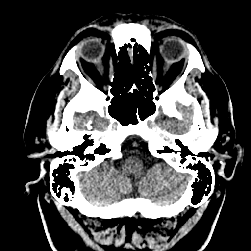 File:Atypical meningioma (WHO grade II) with brain invasion (Radiopaedia 57767-64728 Axial non-contrast 5).png