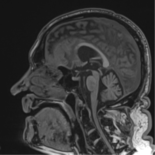 Atypical meningioma (WHO grade II) with brain invasion (Radiopaedia 57767-64729 Sagittal T1 36).png