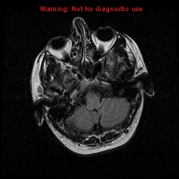 File:Atypical meningioma - grade II (Radiopaedia 13303-13305 Axial FLAIR 4).jpg