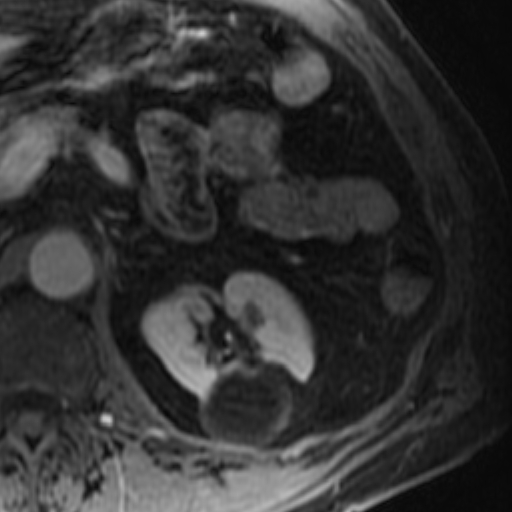 File:Atypical renal cyst on MRI (Radiopaedia 17349-17046 D 12).jpg