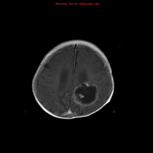 File:Atypical teratoid rhabdoid tumor (Radiopaedia 10712-11183 Axial T1 C+ 4).jpg