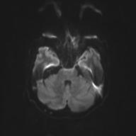 Autoimmune limbic encephalitis (Radiopaedia 30363-31005 Axial B0 and DWI 42).jpg