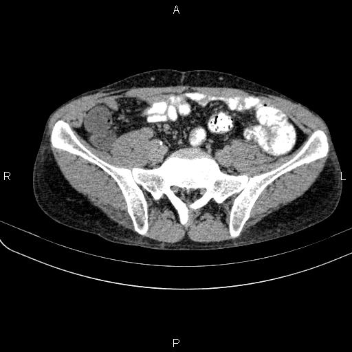 File:Autoimmune pancreatitis (Radiopaedia 84925-100431 Axial C+ delayed 65).jpg