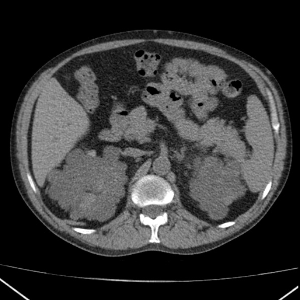 File:Autosomal dominant polycystic kidney disease (Radiopaedia 36539-38101 Axial non-contrast 29).jpg