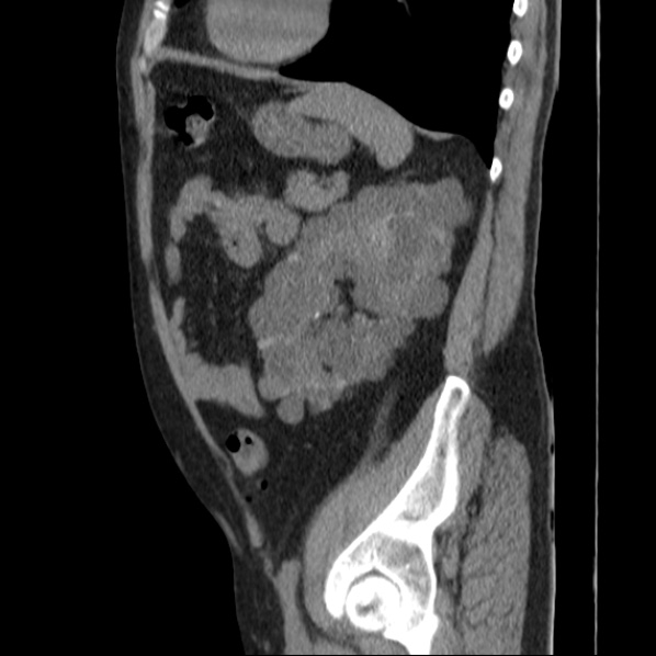 Autosomal dominant polycystic kidney disease (Radiopaedia 36539-38101 D 60).jpg