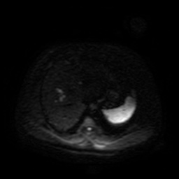 Autosomal dominant polycystic kidney disease (Radiopaedia 50259-55611 Axial DWI 44).jpg