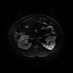 Autosomal dominant polycystic kidney disease (Radiopaedia 50259-55611 Axial DWI 59).jpg