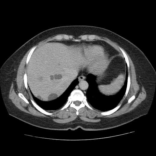 Autosomal dominant polycystic kidney disease with hepatic involvement (Radiopaedia 32693-33662 C 8).jpg