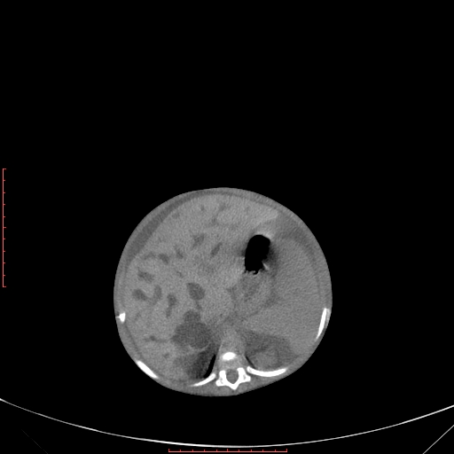 Autosomal recessive polycystic kidney disease associated with Caroli disease (Radiopaedia 61932-69984 Axial non-contrast 137).jpg