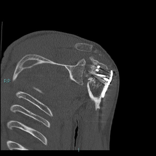 Avascular necrosis after fracture dislocations of the proximal humerus (Radiopaedia 88078-104655 Coronal bone window 80).jpg