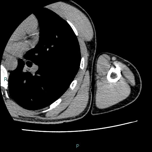 File:Avascular necrosis after fracture dislocations of the proximal humerus (Radiopaedia 88078-104655 D 100).jpg