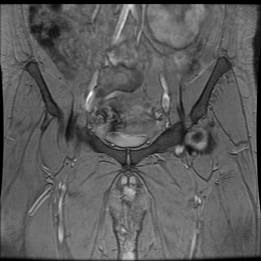 Avascular necrosis of the hip (Radiopaedia 61503-69465 F 20).jpg
