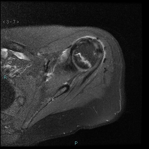 File:Avascular necrosis of the shoulder - Cruess stage I (Radiopaedia 77674-89886 Axial PD fat sat 7).jpg