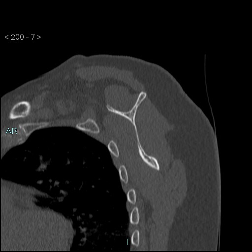 File:Avascular necrosis of the shoulder - Cruess stage I (Radiopaedia 77674-89887 Sagittal bone window 6).jpg