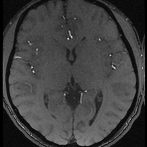 Azygos anterior cerebral artery (Radiopaedia 17059-16756 Axial MRA 14).jpg