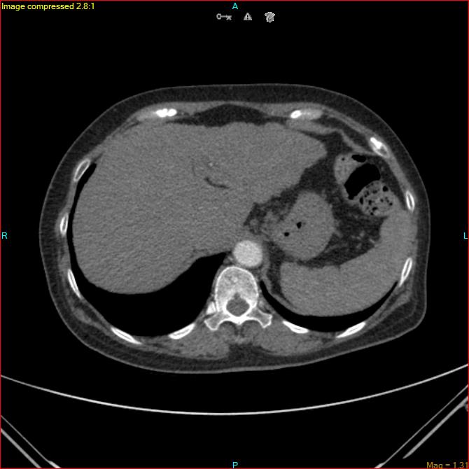 Azygos vein aneurysm (Radiopaedia 77824-90130 B 48).jpg