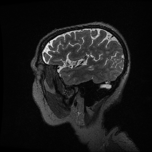 Balo concentric sclerosis (Radiopaedia 53875-59982 Sagittal 3D FSE 49).jpg