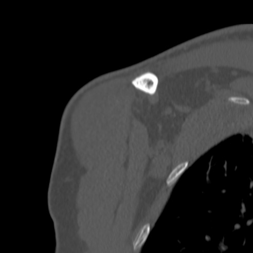 Bankart lesion (Radiopaedia 57256-64185 Coronal bone window 6).jpg