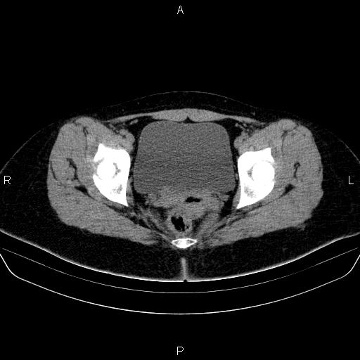 Bartholin gland cyst (Radiopaedia 62635-70930 Axial non-contrast 61).jpg