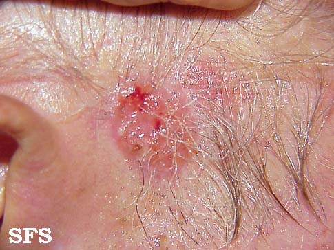 Basal Cell Carcinoma (Dermatology Atlas 19).jpg