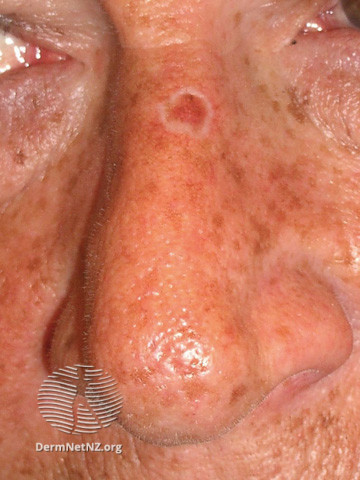 File:Basal cell carcinoma affecting the nose (DermNet NZ lesions-bcc-nose-1093).jpg