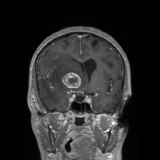 Basal ganglia metastasis (Radiopaedia 78928-91828 Coronal T1 C+ 40).png