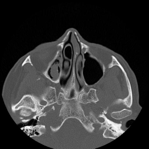File:Base of skull chondrosarcoma (Radiopaedia 30410-31071 Axial bone window 19).jpg