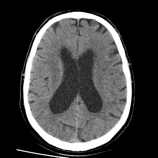 File:Basilar artery occlusion (Radiopaedia 33570-34659 Axial non-contrast 23).png