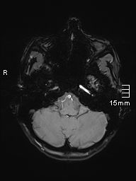 Basilar artery perforator aneurysm (Radiopaedia 82455-99523 Axial SWI 12).jpg