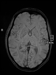 Basilar artery perforator aneurysm (Radiopaedia 82455-99523 Axial SWI 34).jpg