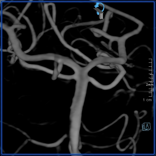 Basilar artery perforator aneurysm (Radiopaedia 82455-99524 3D Left VA 48).jpg