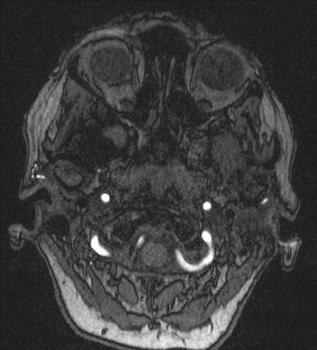 Basilar tip aneurysm (Radiopaedia 26504-26632 MRA 15).jpg