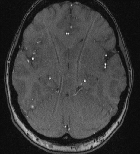 Basilar tip aneurysm (Radiopaedia 26504-26632 MRA 97).jpg