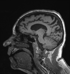 Behavioral variant frontotemporal dementia and late onset schizophrenia (Radiopaedia 52197-58083 Sagittal T1 39).png