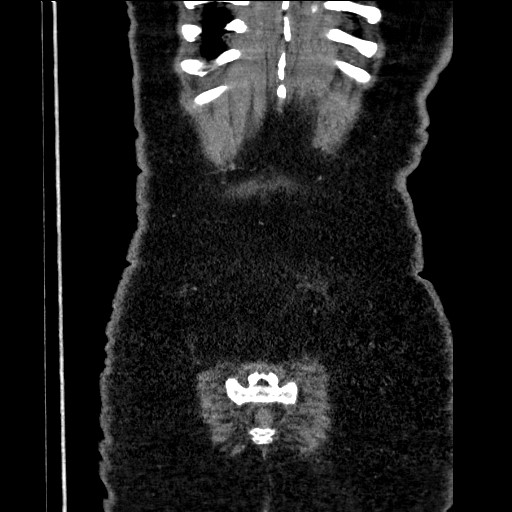 Benign leiomyoma with hydropic features (Radiopaedia 89250-106130 B 103).jpg