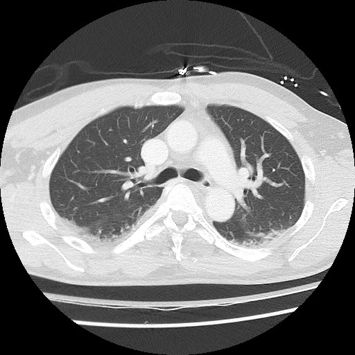 File:Benign post-traumatic pseudopneumoperitoneum (Radiopaedia 71199-81495 Axial lung window 31).jpg