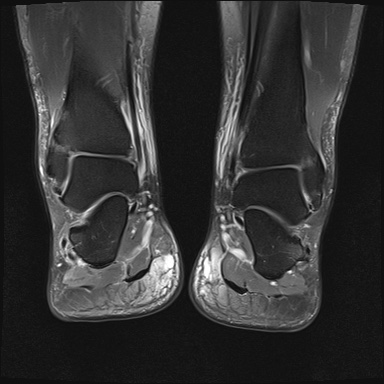 File:Bilateral Achilles tendon complete tear (Radiopaedia 81344-95051 Coronal PD fat sat 9).jpg