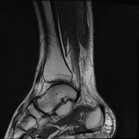 File:Bilateral Achilles tendon complete tear (Radiopaedia 81344-95051 Sagittal T2 20).jpg