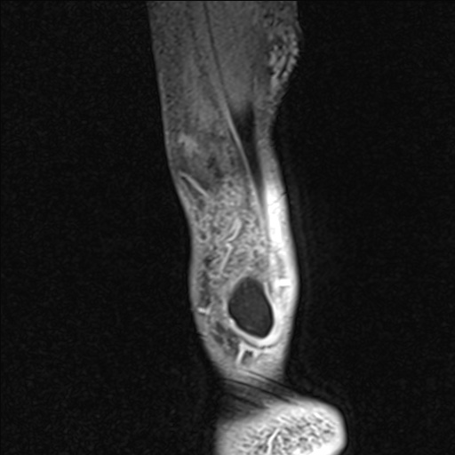 Bilateral Achilles tendon complete tear (Radiopaedia 81344-95051 Sagittal WE - Right 13).jpg