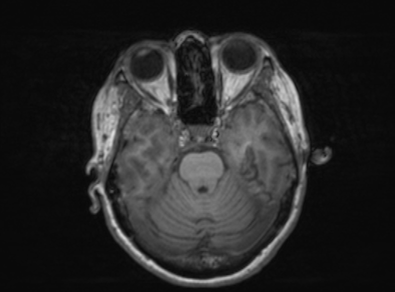 Bilateral PCA territory infarction - different ages (Radiopaedia 46200-51784 Axial T1 285).jpg
