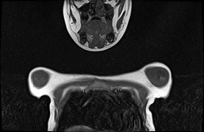 File:Bilateral Sprengel deformity with Klippel-Feil syndrome (Radiopaedia 66395-75650 Coronal T1 2).jpg