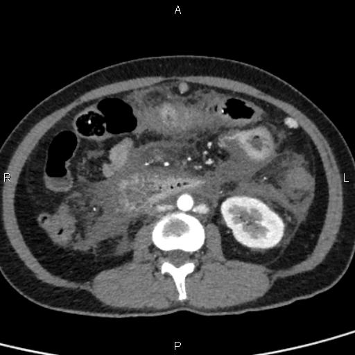 Bilateral adrenal gland hyperenhancement in pancreatitis (Radiopaedia 86642-102753 B 72).jpg