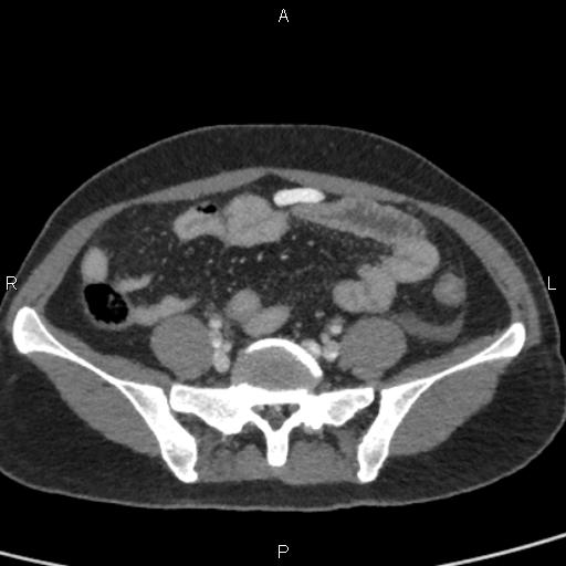 Bilateral adrenal gland hyperenhancement in pancreatitis (Radiopaedia 86642-102753 E 82).jpg