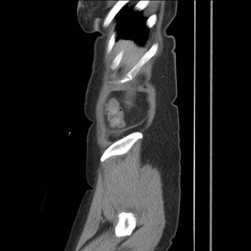Bilateral adrenal granulocytic sarcomas (chloromas) (Radiopaedia 78375-91007 C 25).jpg
