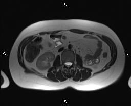 File:Bilateral adrenal myelolipoma (Radiopaedia 63058-71537 Axial T2 22).jpg