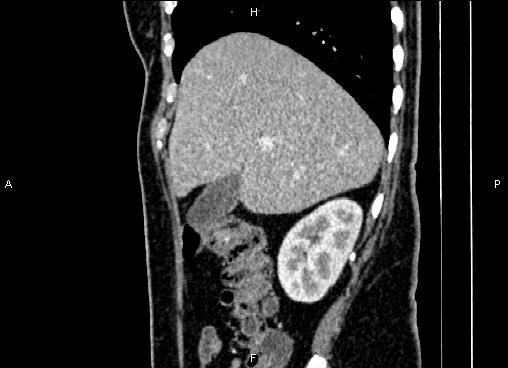Bilateral benign adrenal adenomas (Radiopaedia 86912-103124 E 24).jpg