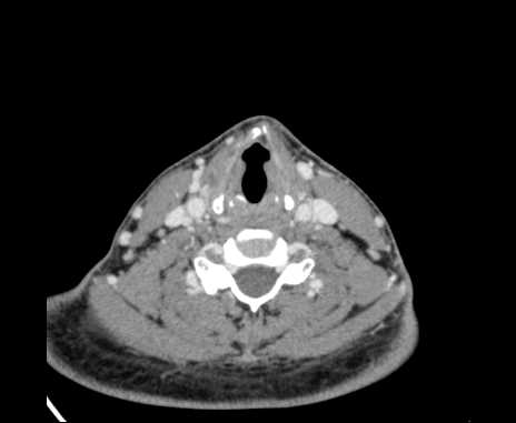 Bilateral carotid body tumors (Radiopaedia 61841-69870 Axial Post contrast 74).jpg