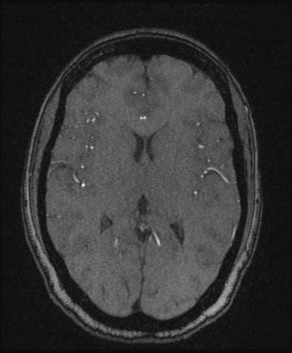 Bilateral carotid body tumors and right glomus jugulare tumor (Radiopaedia 20024-20060 Axial MRA 101).jpg