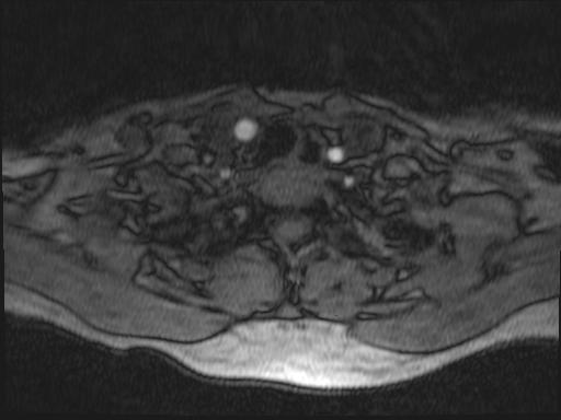 Bilateral carotid body tumors and right glomus jugulare tumor (Radiopaedia 20024-20060 Axial MRA 190).jpg