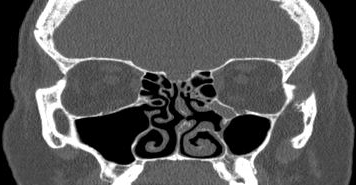 File:Bilateral ectopic infraorbital nerves (Radiopaedia 49006-54084 Coronal 34).png